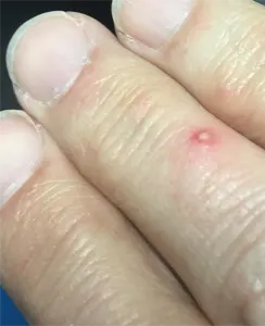 Fire Ant Bite